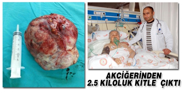 AKCİĞERİNDEN 2.5 KİLOLUK KİTLE ÇIKTI